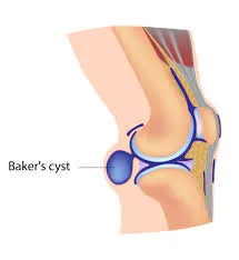 Baker cyste
