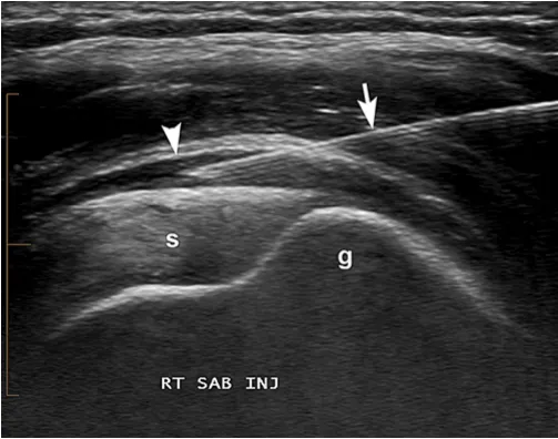Echogeleide injectie bursitis