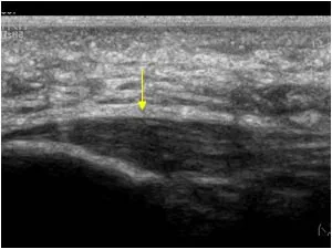 Fasciitis plantaris