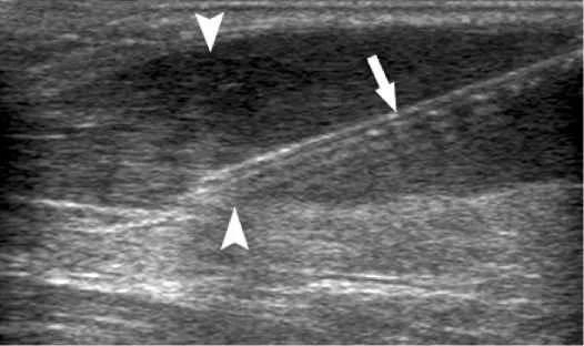 Dry needling procedure