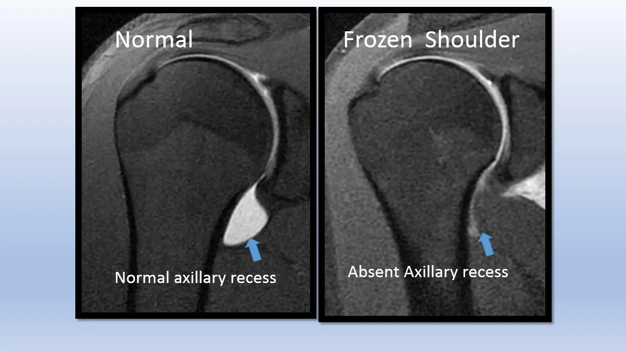 Frozen shoulder diagram