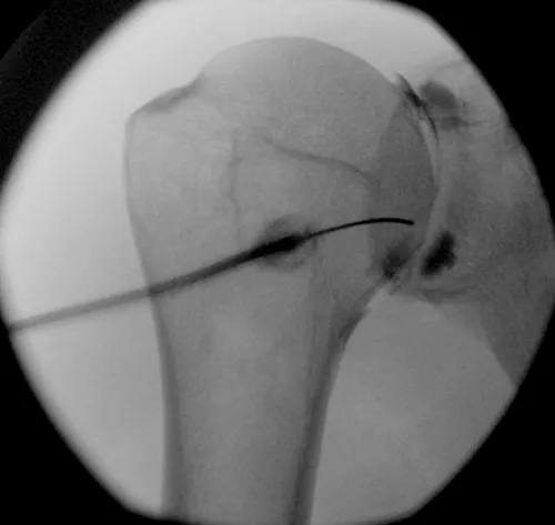 Schouder injectie