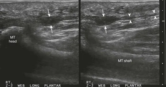 Morton neurinoom anatomie
