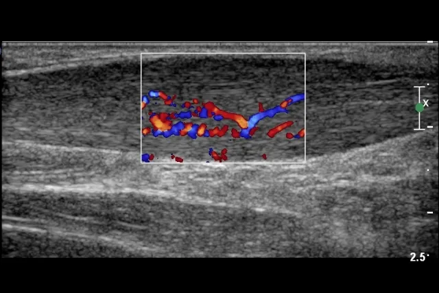 Tendinitis